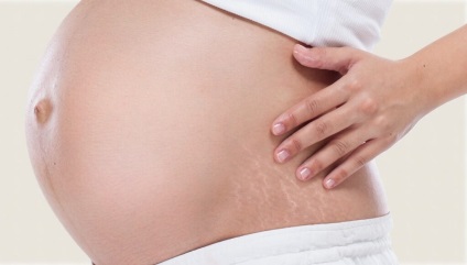 Stretch marks a gyomorfotókról és a jogorvoslatról