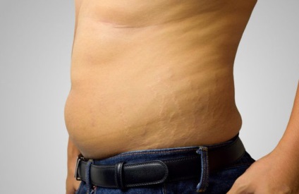 Stretch marks a gyomorfotókról és a jogorvoslatról