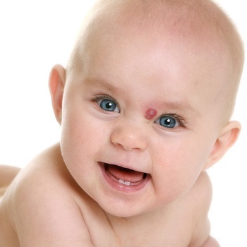 Generikus folt a gyermek homlokán, gyermekek foltjai