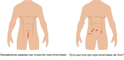 Rolul prostatectomiei și vinci în tratamentul cancerului de prostată