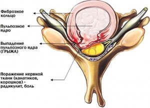 Simptomele și tratamentul unei hernie a coloanei vertebrale cervicale
