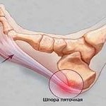Sindromul picioarelor nelinistite - tratament, medicina traditionala