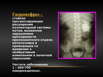 Metode moderne de tratare a hidronefrozei la copii