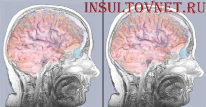 Etapele primului ajutor și reabilitare pentru accident vascular cerebral