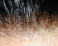 A nullás hajvágás - nem menten alopecia-tól