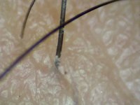 Coafura sub-zero - nu va salva de la alopecie