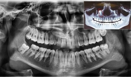 Dinți superfundați - dintele se află în gingie - pe orizontală