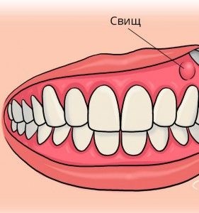 Fistula asupra simptomelor gingiilor și tratamentului la domiciliu