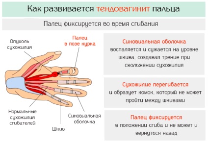 Tendovaginita din degetul arătător - cauze ale inflamației tendoanelor și remediilor