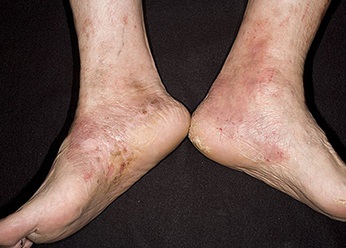 Eczemele eloxate pe corpul uman, tratamentul eczemelor excesive și excesive pe picioare și pe mâini
