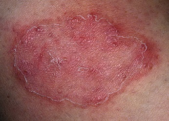 Eczemele eloxate pe corpul uman, tratamentul eczemelor excesive și excesive pe picioare și pe mâini