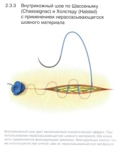 Un manual de instruire pentru supraviețuitori cu privire la tehnica de suprapunere a suturilor chirurgicale, supraviețuitorilor de scrapbookuri