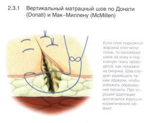 Un manual de instruire pentru supraviețuitori cu privire la tehnica de suprapunere a suturilor chirurgicale, supraviețuitorilor de scrapbookuri