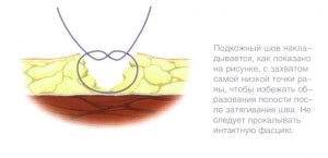 Un manual de instruire pentru supraviețuitori cu privire la tehnica de suprapunere a suturilor chirurgicale, supraviețuitorilor de scrapbookuri