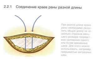 Un manual de instruire pentru supraviețuitori cu privire la tehnica de suprapunere a suturilor chirurgicale, supraviețuitorilor de scrapbookuri