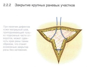 Un manual de instruire pentru supraviețuitori cu privire la tehnica de suprapunere a suturilor chirurgicale, supraviețuitorilor de scrapbookuri