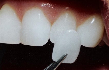 Furnir - restaurare dinti cu ajutorul aparatului german cerec
