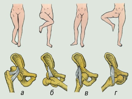 Dislocarea tipurilor articulațiilor de șold, simptome, tratament