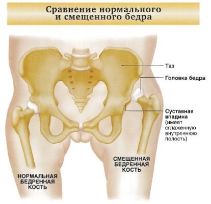 Разместване на видове хип, симптоми, лечение