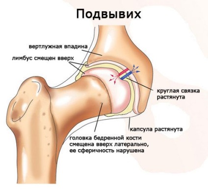 Dislocarea tipurilor articulațiilor de șold, simptome, tratament