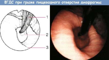 Boli ale esofagului