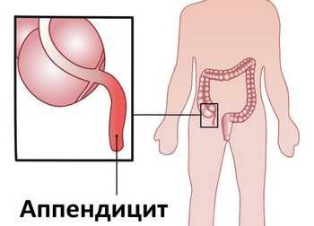 Boli în care doare abdomenul inferior