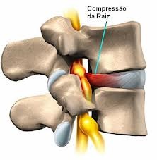 Hernia mediană posterioară a coloanei vertebrale, care este cauza, tratamentul