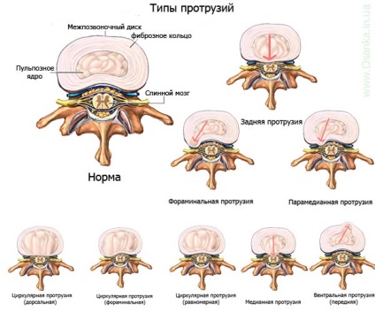Hernia mediană posterioară a coloanei vertebrale, care este cauza, tratamentul