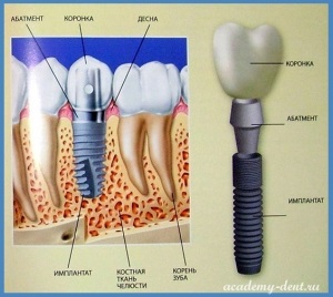 11 Întrebări populare despre implantare cu răspunsuri de specialitate