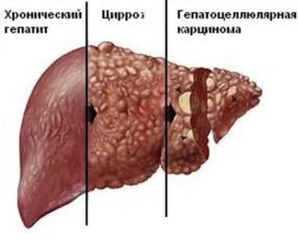 Alcoolice de boală hepatică simptome de leziuni hepatice