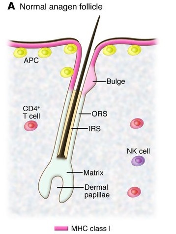 Terapia biologică ca tratament nou pentru alopecia areata