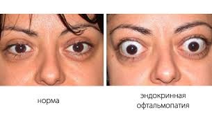 Ce este oftalmopatia endocrină?