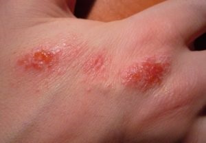 Dermatitis, nedvesítés, kezelés, okok és képek tünetei