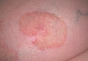 Dermatitis, nedvesítés, kezelés, okok és képek tünetei