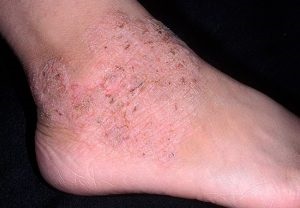 Dermatitis, nedvesítés, kezelés, okok és képek tünetei