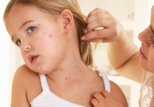 Dermatitis, nedvesítés, kezelés, okok és képek tünetei