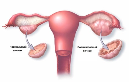 Dieta în ovarele polichistice bazată pe tratament eficient