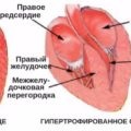 Coardă suplimentară a ventriculului stâng