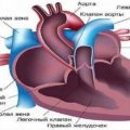 Coardă suplimentară a ventriculului stâng