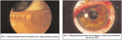 Eroziunea corneei