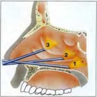 Etape de examinare sistemică endoscopică a nasului