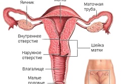 Fibromatoza cauzată de uter, simptome și tratament