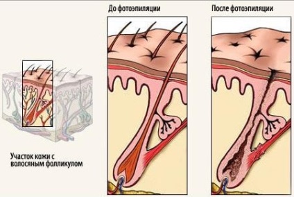 Photoepilarea buzei superioare - ceea ce este și cum să se pregătească corespunzător pentru procedură