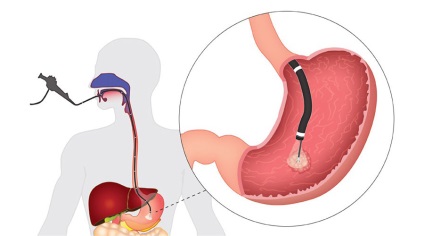 Gastroscopie, spital clinic de oraș