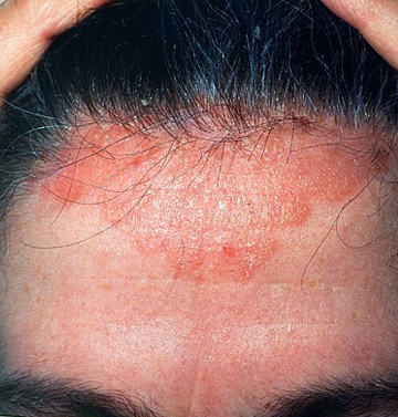 Herpesz a fején a hajkezelésben, tünetek és okok, egészséges online
