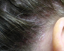 Herpesz a fején a hajkezelésben, tünetek és okok, egészséges online