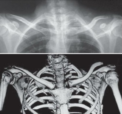 Structura articulară a articulației claviculare, funcția și boala