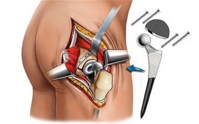 Istoria artroplastiei articulațiilor, literatura medicală, cărți despre medicină, manuale,