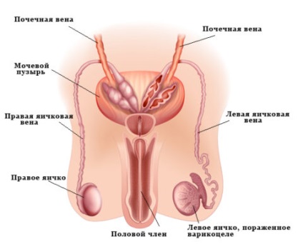 Hogyan kezeljük az 1. fokú varicocele-t?