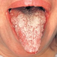 Candidoza cavității orale decât tratarea aftoasă în gură